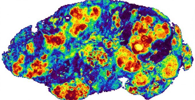 Imagem de espectrometria de massa de tecido tumoral ovariano humano, destacando a distribuição desigual do tratamento de câncer com inibidores de PARP, onde cor